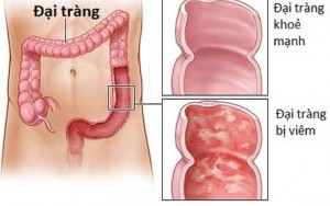 Cách điều trị bệnh viêm đại tràng hiệu quả
