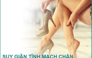 Giãn tĩnh mạch là gì, nguyên nhân gây bệnh và cách phòng ngừa.
