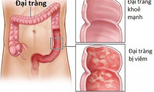 Cách điều trị bệnh viêm đại tràng hiệu quả